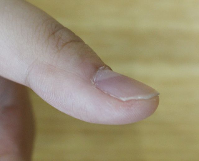 21세 여성 · 2개월 경과